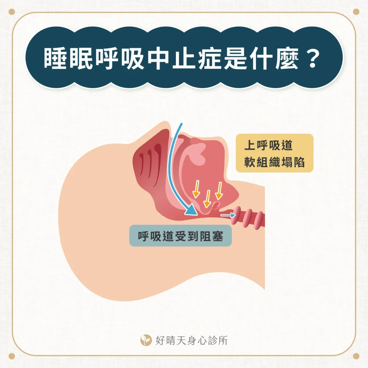 睡眠呼吸中止症是什麼？