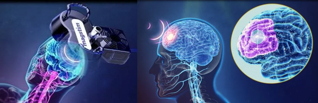 TMS治療、經顱磁刺激治療(左)、經顱磁刺激治療(右)