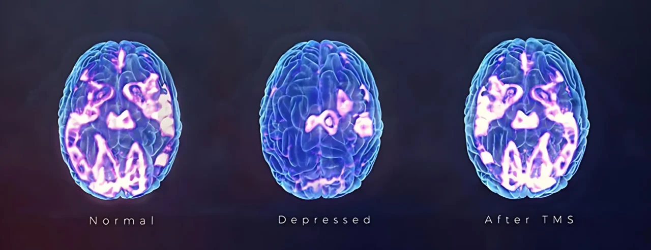 正常人、憂鬱症個案及憂鬱症個案經過TMS治療後的功能性腦影像變化，亮部表示功能活躍